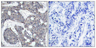 Immunohistochemical analysis of paraffin-embedded human breast carcinoma tissue using HSP27(Phospho-Ser82) Antibody(left) or the same antibody preincubated with blocking peptide(right).Rabbit anti-Human HSPB1 Polyclonal Antibody