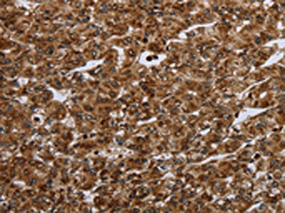 The image on the left is immunohistochemistry of paraffin-embedded Human prostate cancer tissue using CERS1 Antibody(CERS1 Antibody) at dilution 1/20, on the right is treated with synthetic peptide. (Original magnification: ×200)Rabbit anti-Human CERS1 Polyclonal Antibody