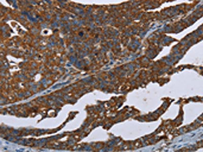 The image on the left is immunohistochemistry of paraffin-embedded Human ovarian cancer tissue using the antibody Antibody) at dilution 1/20, on the right is treated with synthetic peptide. (Original magnification: ×200)Rabbit anti-Human CERS1 Polyclonal Antibody
