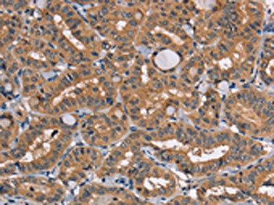 The image on the left is immunohistochemistry of paraffin-embedded Human thyroid cancer tissue using the antibody Antibody) at dilution 1/20, on the right is treated with fusion protein. (Original magnification: ×200)Rabbit anti-Human TRAFD1 Polyclonal Antibody