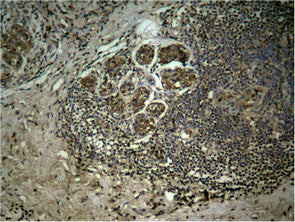 Immunohistochemical analysis of paraffin-embedded human breast carcinoma tissue using Histone H3 (Tri-Methyl-Lys27) Antibody.Rabbit anti-Human HIST1H3A Polyclonal Antibody