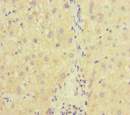 Immunohistochemistry of paraffin-embedded human liver cancer using RAB18 Antibody at dilution of 1:100Rabbit anti-Human RAB18 Polyclonal Antibody