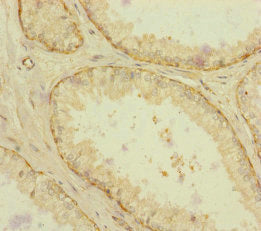 Immunohistochemistry of paraffin-embedded human prostate cancer using RAB18 Antibody at dilution of 1:100Rabbit anti-Human RAB18 Polyclonal Antibody