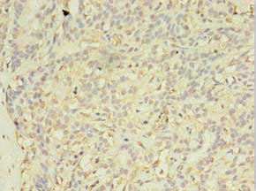 Immunohistochemistry of paraffin-embedded human breast cancer using EXOSC5 Antibody at dilution of 1:100Rabbit anti-Human EXOSC5 Polyclonal Antibody