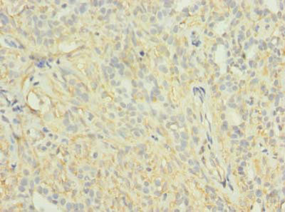 Immunohistochemistry of paraffin-embedded human breast cancer using the antibody at dilution of 1:100