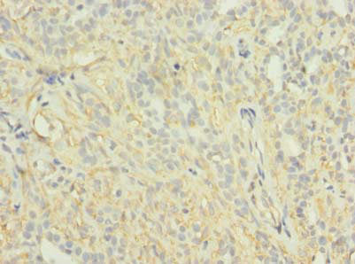 Immunohistochemistry of paraffin-embedded human breast cancer using the antibody at dilution of 1:100