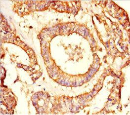 Immunohistochemistry of paraffin-embedded human endometrial cancer using the antibody at dilution of 1:100