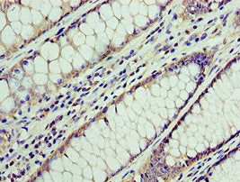 Immunohistochemistry of paraffin-embedded human colon cancer using ATAD3A Antibody at dilution of 1:100Rabbit anti-Human ATAD3A Polyclonal Antibody