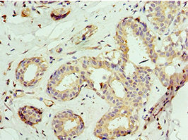Immunohistochemistry of paraffin-embedded human breast cancer using ATAD3A Antibody at dilution of 1:100Rabbit anti-Human ATAD3A Polyclonal Antibody