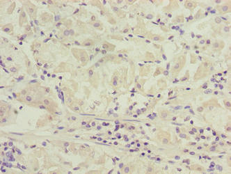 Immunohistochemistry of paraffin-embedded human gastric cancer using SLC52A1 Antibody at dilution of 1:100Rabbit anti-Human SLC52A1 Polyclonal Antibody