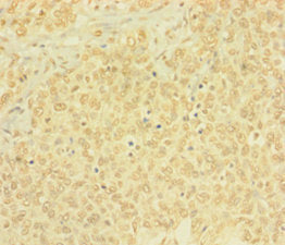 Immunohistochemistry of paraffin-embedded human ovarian cancer using the antibody at dilution of 1: 100