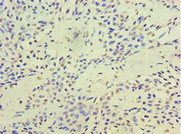 Immunohistochemistry of paraffin-embedded human breast cancer using the antibody at dilution of 1:100Rabbit anti-Human TERF2IP Polyclonal Antibody
