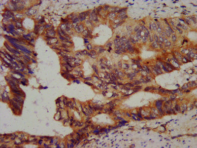 IHC image of the antibody diluted at 1:800 and staining in paraffin-embedded human colon cancer performed on a Leica BondTM system. After dewaxing and hydration, antigen retrieval was mediated by high pressure in a citrate buffer (pH 6.0). Section was blocked with 10% normal goat serum 30min at RT. Then primary antibody (1% BSA) was incubated at 4°C overnight. The primary is detected by a biotinylated secondary antibody and visualized using an HRP conjugated SP system.