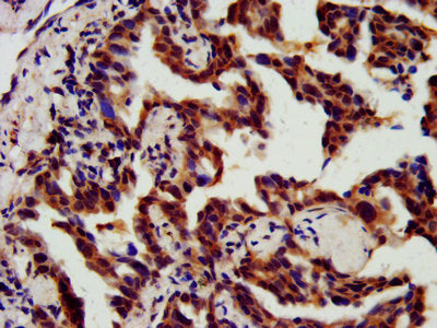 IHC image of CHMP5 Antibody diluted at 1:800 and staining in paraffin-embedded human lung cancer performed on a Leica BondTM system. After dewaxing and hydration, antigen retrieval was mediated by high pressure in a citrate buffer (pH 6.0). Section was blocked with 10% normal goat serum 30min at RT. Then primary antibody (1% BSA) was incubated at 4°C overnight. The primary is detected by a biotinylated secondary antibody and visualized using an HRP conjugated SP system.