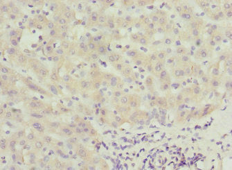 Immunohistochemistry of paraffin-embedded human liver cancer using CALCOCO1 Antibody at dilution of 1:100