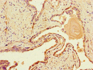 Immunohistochemistry of paraffin-embedded human prostate cancer using the antibody at dilution of 1:100Rabbit anti-Human DNAH1 Polyclonal Antibody