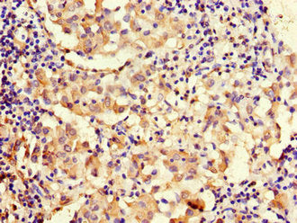 Immunohistochemistry of paraffin-embedded human lung cancer using MAP10 Antibody at dilution of 1:100