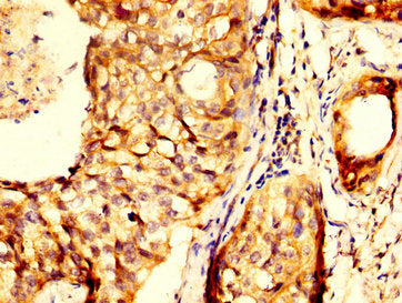 IHC image of RHCG Antibody diluted at 1:300 and staining in paraffin-embedded human cervical cancer performed on a Leica BondTM system. After dewaxing and hydration, antigen retrieval was mediated by high pressure in a citrate buffer (pH 6.0). Section was blocked with 10% normal goat serum 30min at RT. Then primary antibody (1% BSA) was incubated at 4°C overnight. The primary is detected by a biotinylated secondary antibody and visualized using an HRP conjugated SP system.Rabbit anti-Human RHCG Polyclonal Antibody