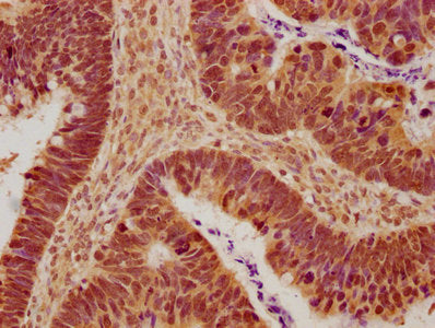 IHC image of the antibody diluted at 1:600 and staining in paraffin-embedded human ovarian cancer performed on a Leica BondTM system. After dewaxing and hydration, antigen retrieval was mediated by high pressure in a citrate buffer (pH 6.0). Section was blocked with 10% normal goat serum 30min at RT. Then primary antibody (1% BSA) was incubated at 4°C overnight. The primary is detected by a biotinylated secondary antibody and visualized using an HRP conjugated SP system.Rabbit anti-Human TJP2 Polyclonal Antibody