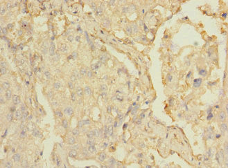 Immunohistochemistry of paraffin-embedded human lung cancer using MARCO Antibody at dilution of 1:100Rabbit anti-Human MARCO Polyclonal Antibody