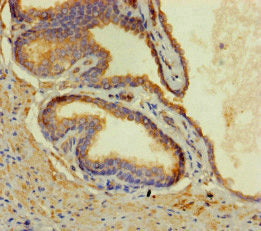 Immunohistochemistry of paraffin-embedded human prostate cancer using the antibody at dilution of 1:100Rabbit anti-Human CORO1B Polyclonal Antibody