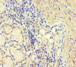 Immunohistochemistry of paraffin-embedded human gastric cancer using CORO1B Antibody at dilution of 1:100Rabbit anti-Human CORO1B Polyclonal Antibody