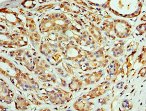 Immunohistochemistry of paraffin-embedded human breast cancer using COPS4 Antibody at dilution of 1:100Rabbit anti-Human COPS4 Polyclonal Antibody