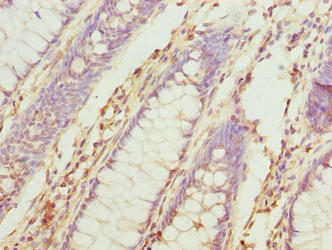 Immunohistochemistry of paraffin-embedded human colon cancer using TUBB6 Antibody at dilution of 1:100Rabbit anti-Human TUBB6 Polyclonal Antibody