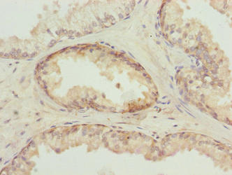 Immunohistochemistry of paraffin-embedded human prostate cancer using TUBB6 Antibody at dilution of 1:100Rabbit anti-Human TUBB6 Polyclonal Antibody