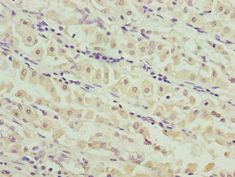 Immunohistochemistry of paraffin-embedded human gastric cancer using MND1 Antibody at dilution of 1:100Rabbit anti-Human MND1 Polyclonal Antibody