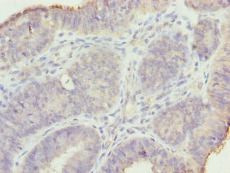 Immunohistochemistry of paraffin-embedded human endometrial cancer using MND1 Antibody at dilution of 1:100Rabbit anti-Human MND1 Polyclonal Antibody
