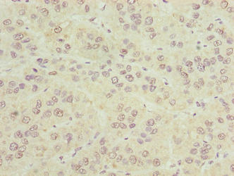 Immunohistochemistry of paraffin-embedded human liver cancer using CIPC Antibody at dilution of 1:100Rabbit anti-Human CIPC Polyclonal Antibody
