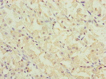 Immunohistochemistry of paraffin-embedded human gastric cancer using CEP44 Antibody at dilution of 1:100Rabbit anti-Human CEP44 Polyclonal Antibody