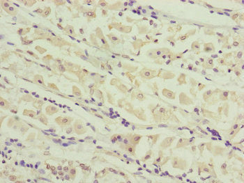 Immunohistochemistry of paraffin-embedded human gastric cancer using CEP44 Antibody at dilution of 1:100Rabbit anti-Human CEP44 Polyclonal Antibody