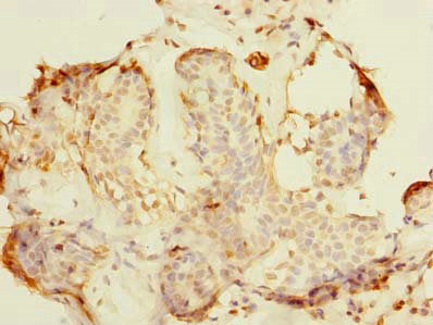 Immunohistochemistry of paraffin-embedded human breast cancer using NIF3L1 Antibody at dilution of 1:100Rabbit anti-Human NIF3L1 Polyclonal Antibody