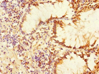 Immunohistochemistry of paraffin-embedded human colon cancer using PLK3 Antibody at dilution of 1:100Rabbit anti-Human PLK3 Polyclonal Antibody