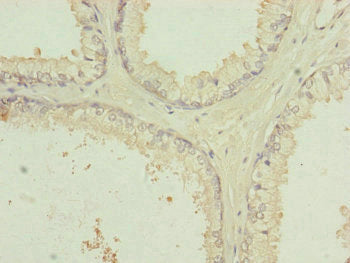 Immunohistochemistry of paraffin-embedded human prostate cancer using RNF41 Antibody at dilution of 1:100Rabbit anti-Human RNF41 Polyclonal Antibody