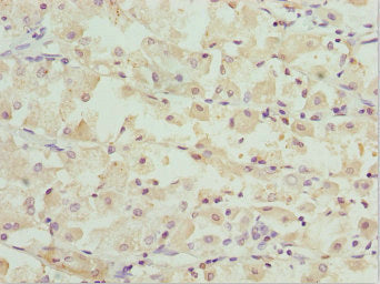 Immunohistochemistry of paraffin-embedded human gastric cancer using OPA3 Antibody at dilution of 1:100Rabbit anti-Human OPA3 Polyclonal Antibody