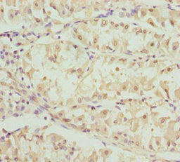 Immunohistochemistry of paraffin-embedded human gastric cancer using OPA3 Antibody at dilution of 1:100Rabbit anti-Human OPA3 Polyclonal Antibody