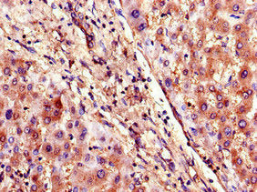 Immunohistochemistry of paraffin-embedded human liver tissue using the antibody at dilution of 1:100Rabbit anti-Human SLCO1B3 Polyclonal Antibody