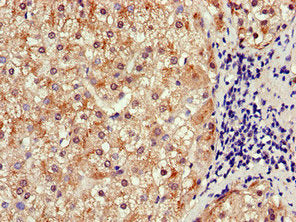 Immunohistochemistry of paraffin-embedded human liver cancer using SLCO1B3 Antibody at dilution of 1:100Rabbit anti-Human SLCO1B3 Polyclonal Antibody