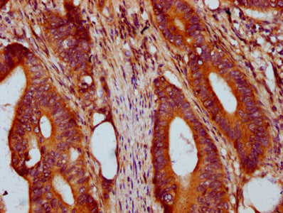 IHC image of PRSS16 Antibody diluted at 1:400 and staining in paraffin-embedded human colon cancer performed on a Leica BondTM system. After dewaxing and hydration, antigen retrieval was mediated by high pressure in a citrate buffer (pH 6.0). Section was blocked with 10% normal goat serum 30min at RT. Then primary antibody (1% BSA) was incubated at 4°C overnight. The primary is detected by a biotinylated secondary antibody and visualized using an HRP conjugated SP system.Rabbit anti-Human PRSS16 Polyclonal Antibody