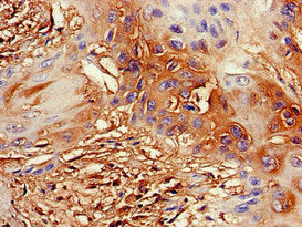 Immunohistochemistry of paraffin-embedded human cervical cancer using the antibody at dilution of 1:100Rabbit anti-Human DDX4 Polyclonal Antibody