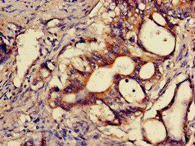 Immunohistochemistry of paraffin-embedded human colon cancer using the antibody at dilution of 1:100Rabbit anti-Human SNX15 Polyclonal Antibody