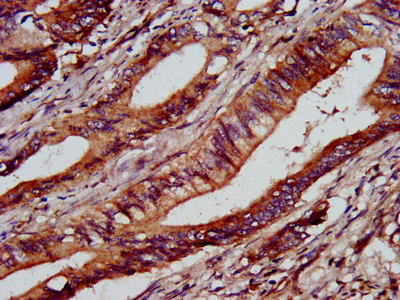 IHC image of C1GALT1 Antibody diluted at 1:1000 and staining in paraffin-embedded human colon cancer performed on a Leica BondTM system. After dewaxing and hydration, antigen retrieval was mediated by high pressure in a citrate buffer (pH 6.0). Section was blocked with 10% normal goat serum 30min at RT. Then primary antibody (1% BSA) was incubated at 4°C overnight. The primary is detected by a biotinylated secondary antibody and visualized using an HRP conjugated SP system.