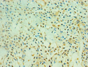 Immunohistochemistry of paraffin-embedded human breast cancer using SIRT3 Antibody at dilution of 1:100Rabbit anti-Human SIRT3 Polyclonal Antibody