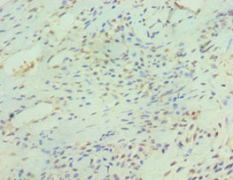 Immunohistochemistry of paraffin-embedded human breast cancer using SIRT3 Antibody at dilution of 1:100Rabbit anti-Human SIRT3 Polyclonal Antibody