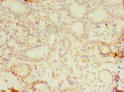 Immunohistochemistry of paraffin-embedded human breast cancer using KBTBD4 Antibody at dilution of 1:100
