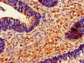 Immunohistochemistry of paraffin-embedded human ovarian cancer using RMND1 Antibody at dilution of 1:100Rabbit anti-Human RMND1 Polyclonal Antibody