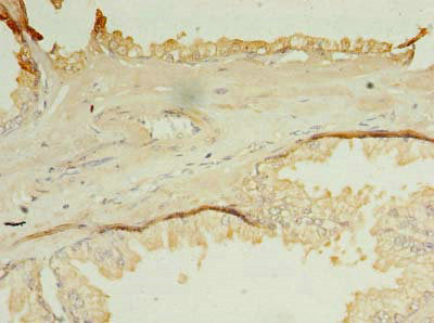 Immunohistochemistry of paraffin-embedded human prostate cancer using OCIAD1 Antibody at dilution of 1:100Rabbit anti-Human OCIAD1 Polyclonal Antibody